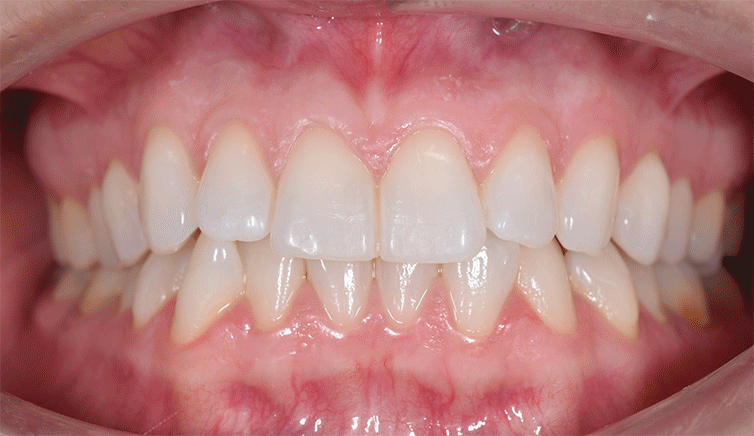 LAURA-TODAS-A-INICIALES-ANTES-Y-DESPUES.