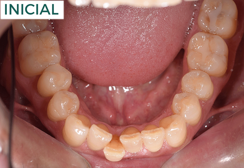 ANTONIO-OCLUSAL-INFERIOR-BAJA-COMPLEJ-UN