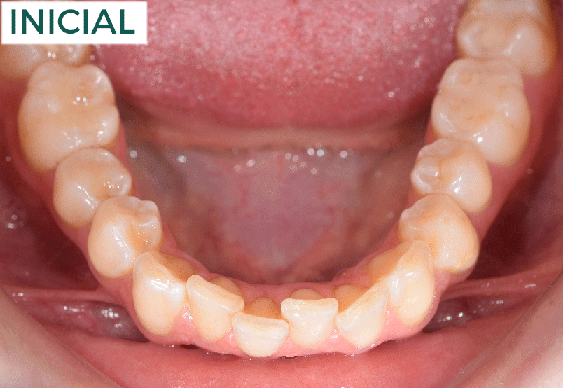 SAMIA-OCLUSAL-INF-MODERADA-COMPLEJ-UNA-F