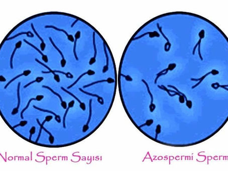 Azoospermia: Causes, Diagnosis and Treatment Options