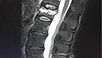 Kyphoplasty vs. vertebroplasty in the treatment of spinal compression