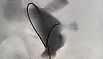 Percutaneous Nephrostomy for a Dilated Collecting System