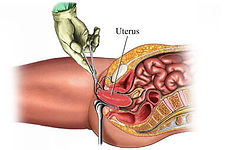 Diagram of vaginal hysterectomy