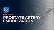 Prostate Artery Embolization