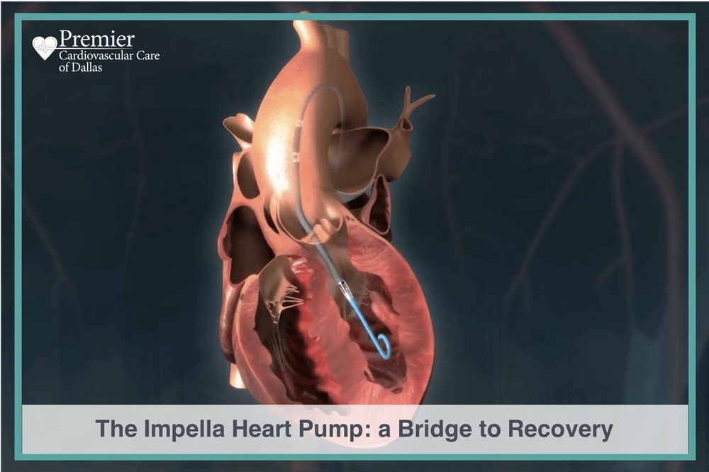 Impella Heart Pump in Cardiogenic Shock Premier Cardiovascular
