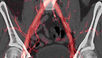 Medical image of peripheral artery disease