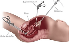 Diagram of laparoscopic hysterectomy technique