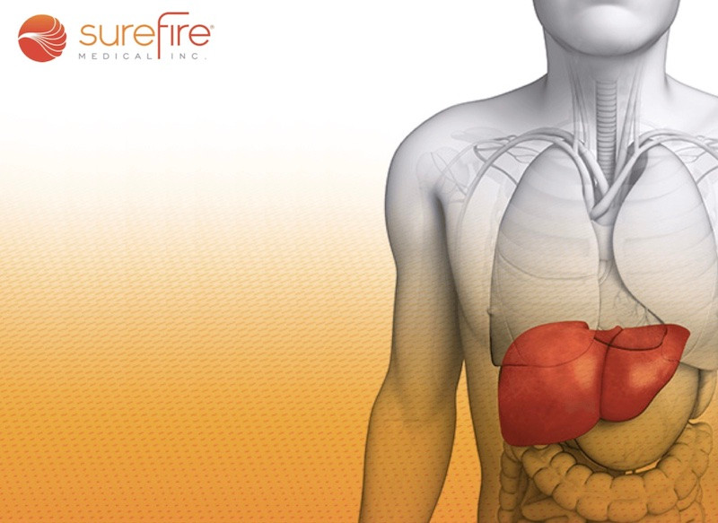 surefire-radial-access-liver