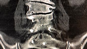 Discoplasty and vertebral augmentation