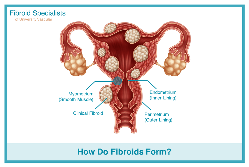 How Do Fibroids Form Fibroid Specialists
