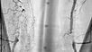 Medical image of peripheral artery disease showing arteries in red