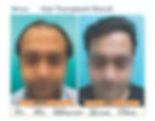 hair transplant in delhi