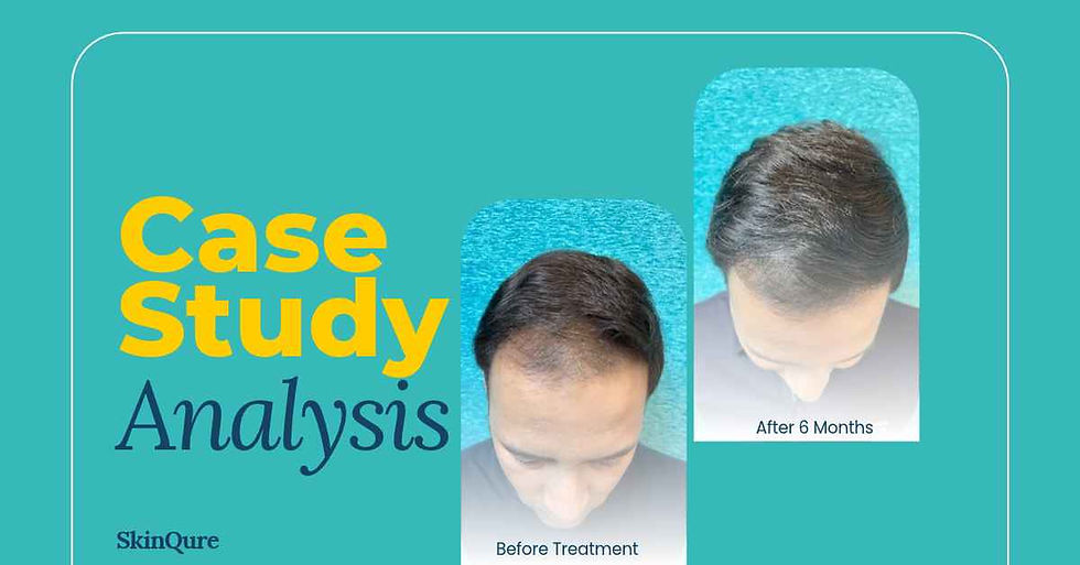 Case Study - Male Pattern Hair Loss Treatment in Delhi