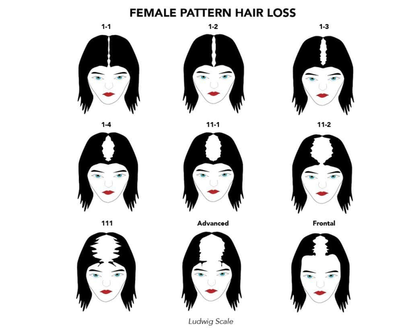 female pattern baldness