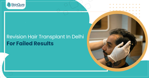 Revision hair transplant in Delhi for failed results — expert hair restoration at SkinQure Clinic