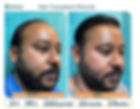 hair transplant results in delhi