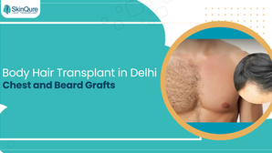 Body hair transplant in Delhi showing chest hair restoration and beard graft procedure for natural-looking results at SkinQure Hair Transplant clinic.