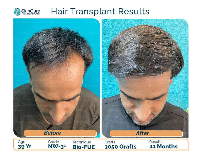 hair transplant in delhi