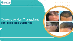 Corrective hair transplant for failed hair surgeries showing before and after results with restored natural hairline at SkinQure Hair Transplant clinic.