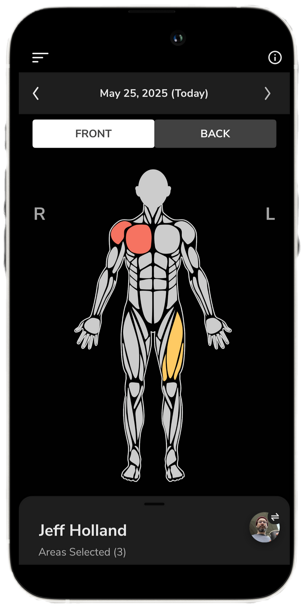 Muscle Soreness