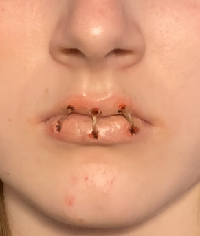Sewn Shut (1).PNG