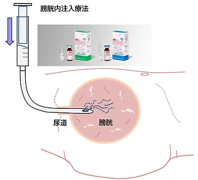膀胱内注入療法_edited.jpg