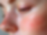 Vascular IPL Trowbridge Laser Clinic Skin Confidence Pro.png