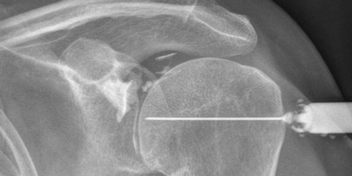 arthrographie de l'épaule