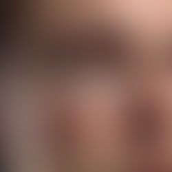 Cicatrici da Acne: Perché rimangono segni sulla pelle?