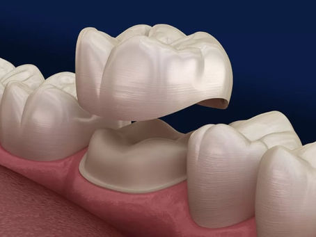 Dental Crowns: Restore and Strengthen Your Teeth