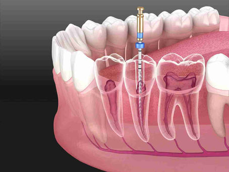 Root Canal Treatment: Save Your Natural Tooth and Relieve Pain