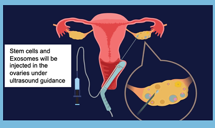 Exosome Therapy for POI and Diminished Ovarian Reserve