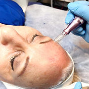 best-microneedling-adelaide-medical-lasers_edited.jpg