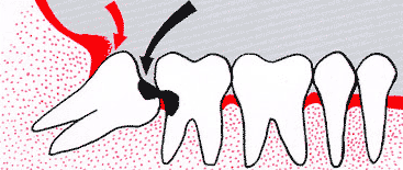 Wisdom Teeth