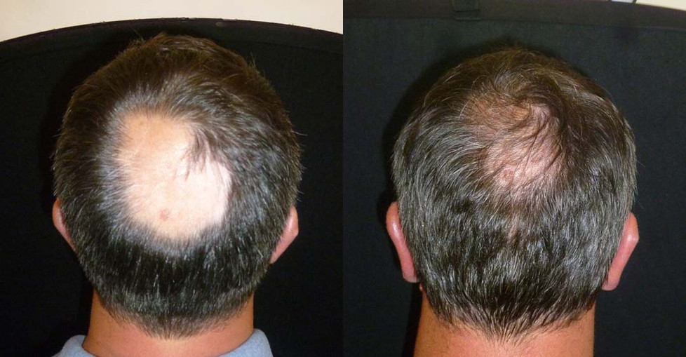 Alopecia Areata Harley Street London Hair Loss Clinic