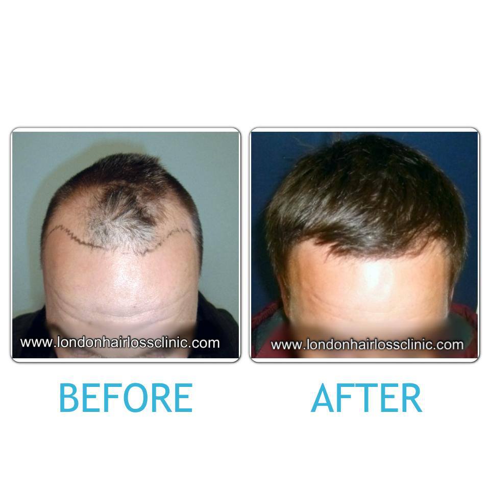 Before & After London Hair Loss Clinic