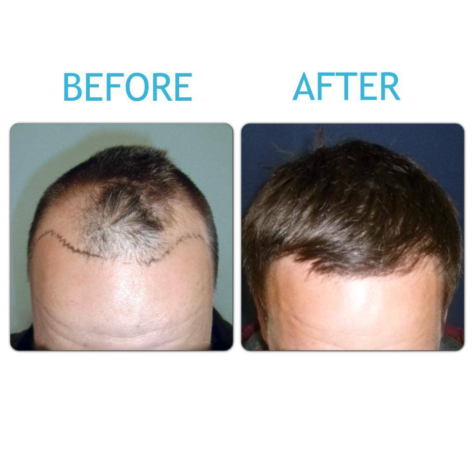 Before & After London Hair Loss Clinic