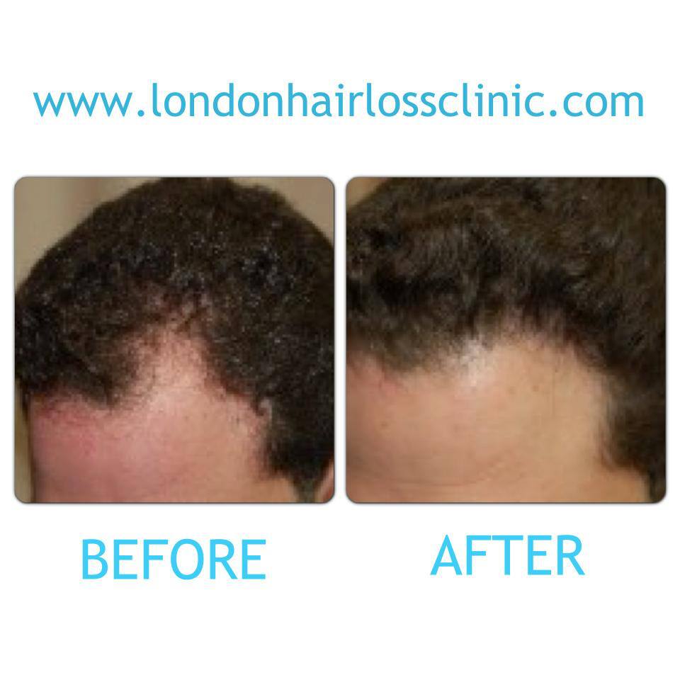 Before & After London Hair Loss Clinic