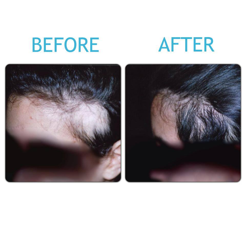 Before & After London Hair Loss Clinic