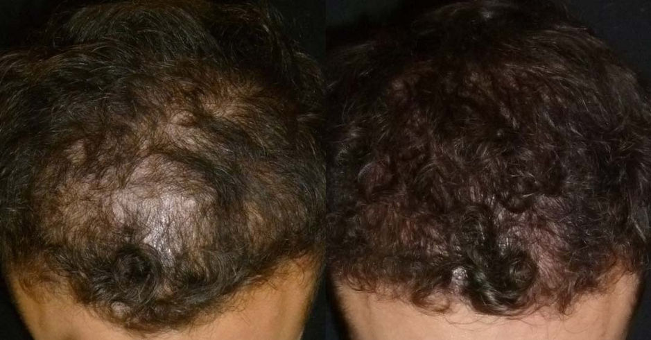 PRP Hair Treatment Results