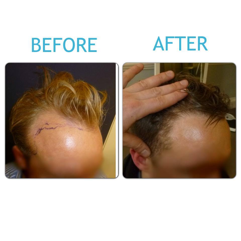 Before & After London Hair Loss Clinic