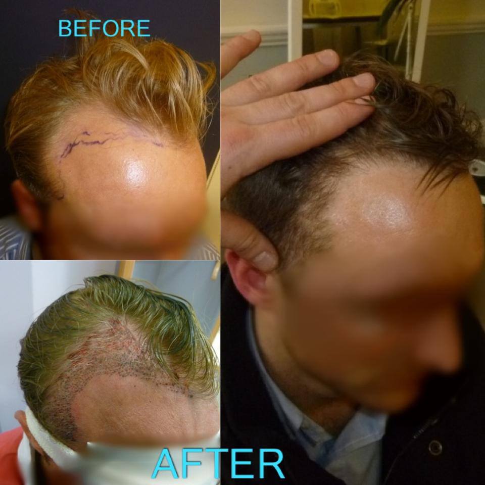 Before & After London Hair Loss Clinic