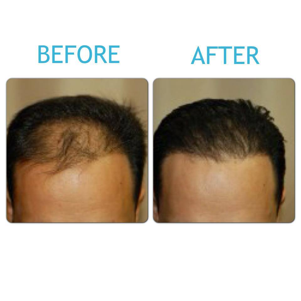 Before & After London Hair Loss Clinic