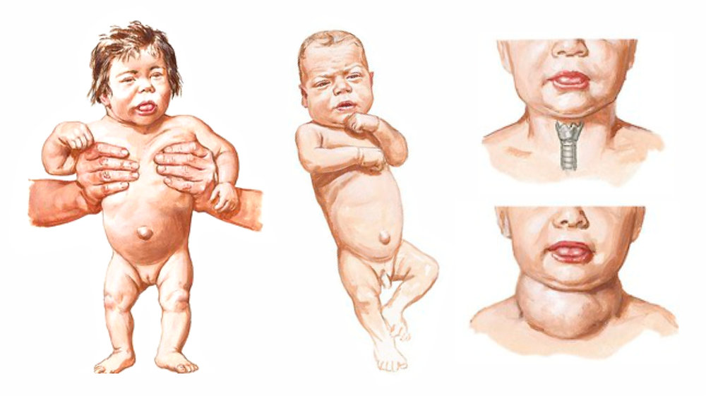 hipotiroid kongenital