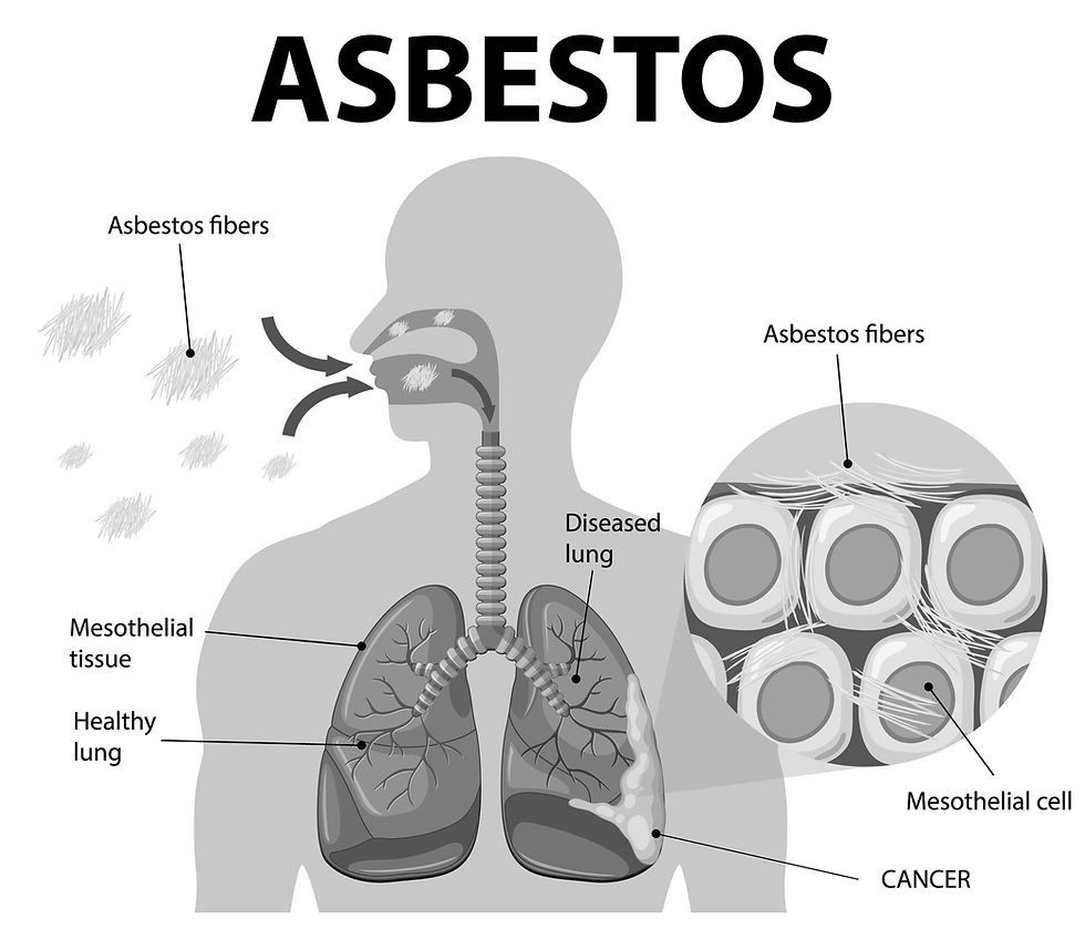 Illustration of how the inhalation of asbestos Fibers Into the lungs leads to mesothelioma or lung cancer over time.
