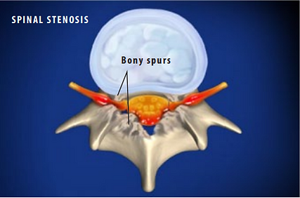 spinal stenosis