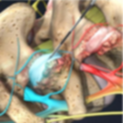 facet injection treatment