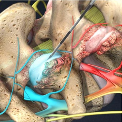 facet injection treatment