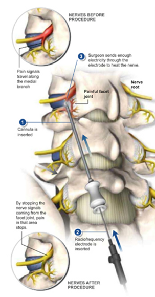 nerve before procedure