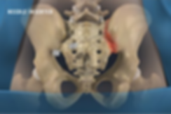 needle inserted